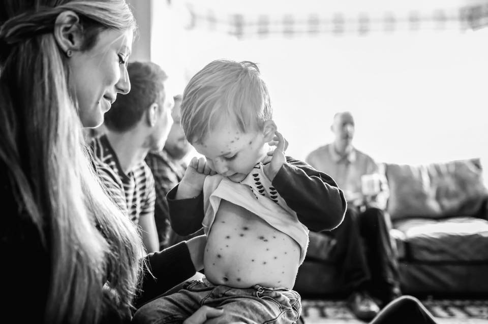 child with chicken pox - Documentary Family Photography